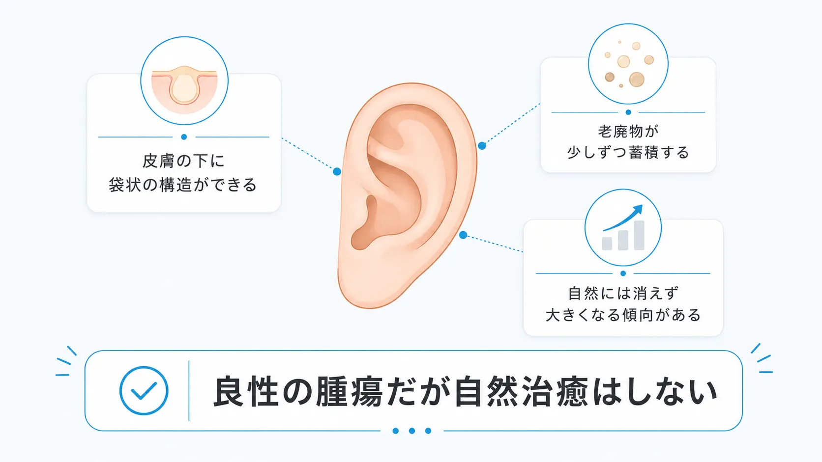 耳たぶの粉瘤の仕組みと特徴を示すインフォグラフィック