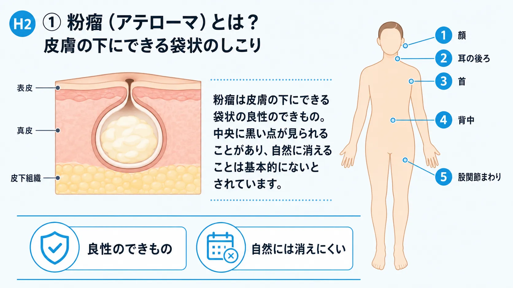 粉瘤(アテローマ)の構造とできやすい部位を示すインフォグラフィック。皮膚断面図と好発部位を解説。