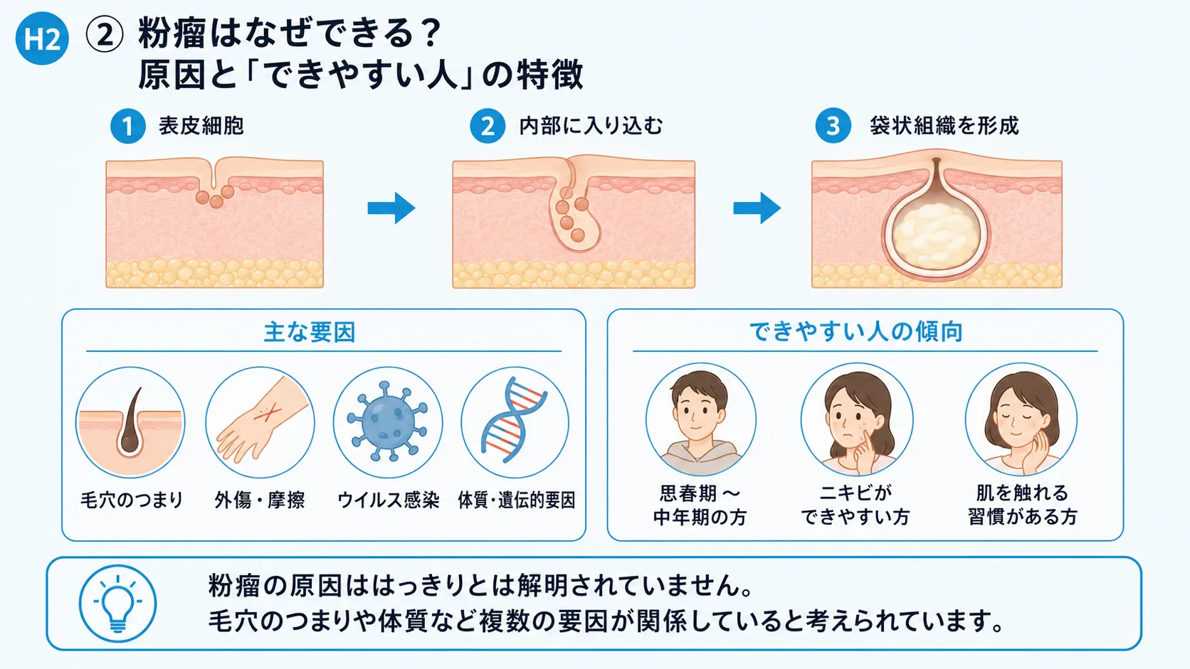 粉瘤ができる原因とできやすい人の特徴を示すインフォグラフィック。発生メカニズムと主な要因を解説。