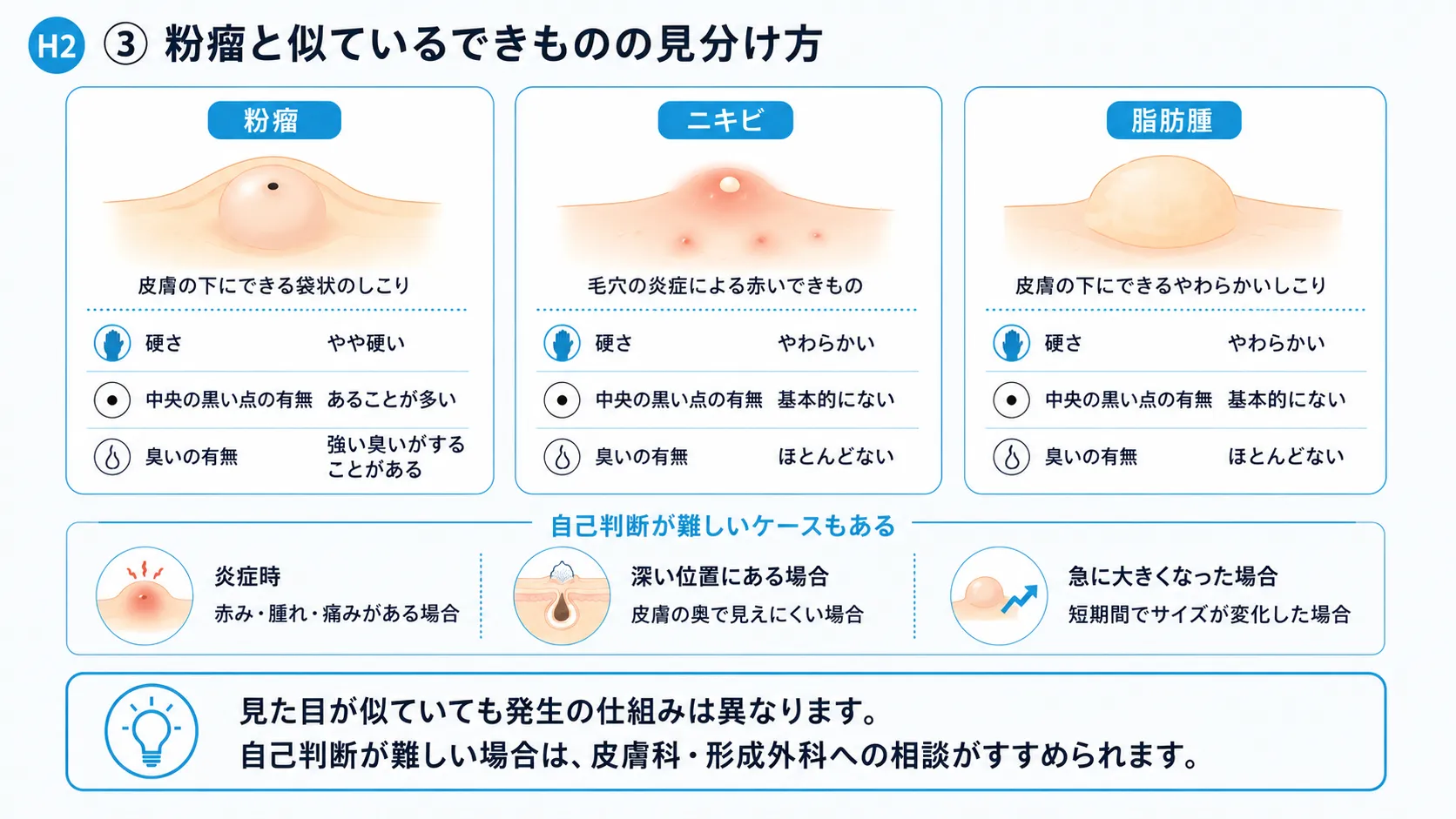 粉瘤・ニキビ・脂肪腫の違いを比較するインフォグラフィック。硬さ・黒い点の有無・臭いを整理。