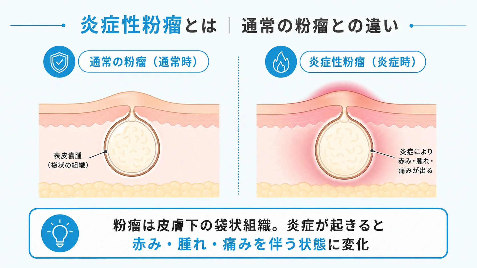炎症性粉瘤とは|通常の粉瘤との違い 通常の粉瘤と炎症性粉瘤の状態を比較したインフォグラフィック