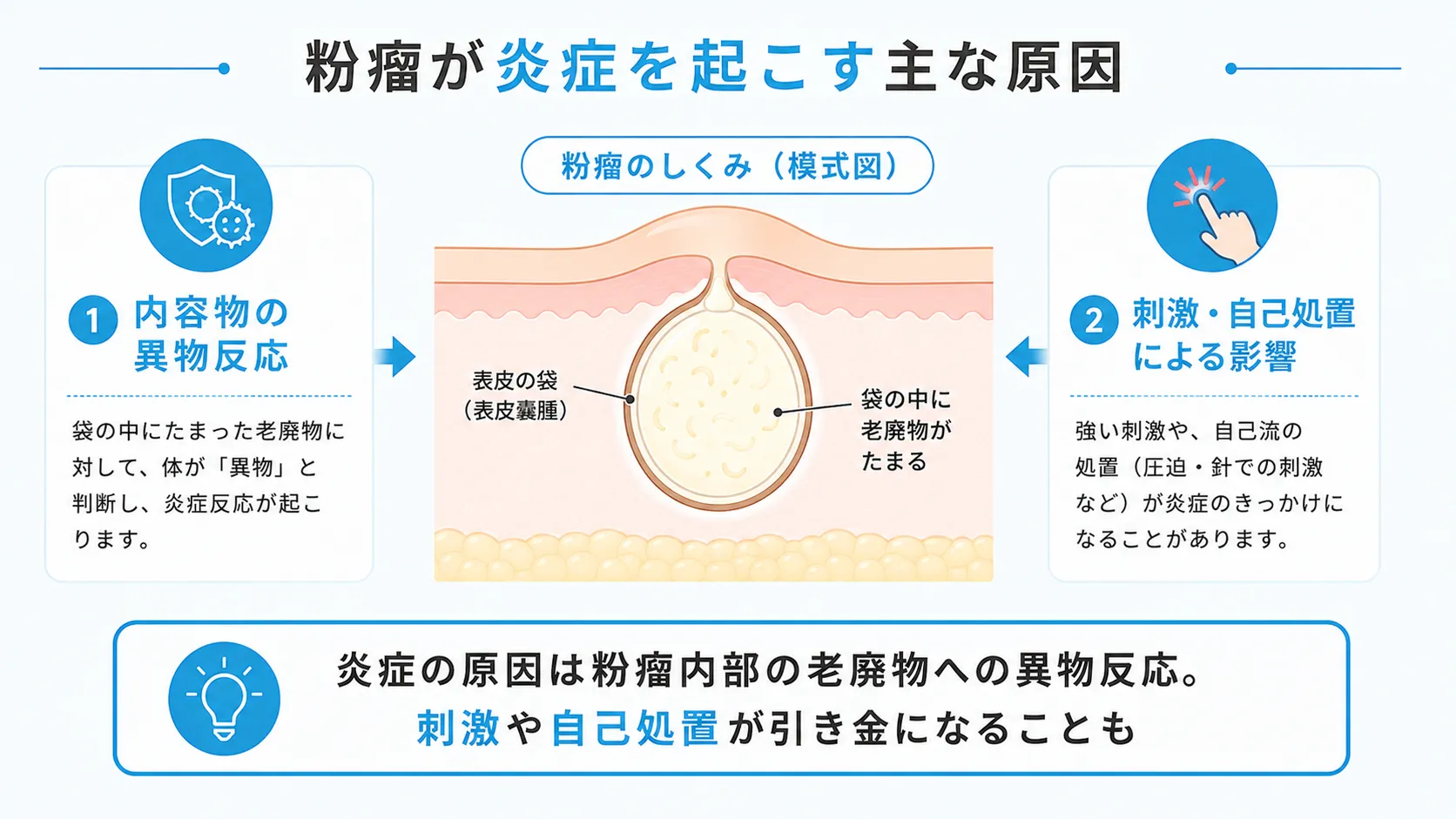 粉瘤が炎症を起こす主な原因 粉瘤が炎症を起こす原因(異物反応・刺激や自己処置)を解説したインフォグラフィック