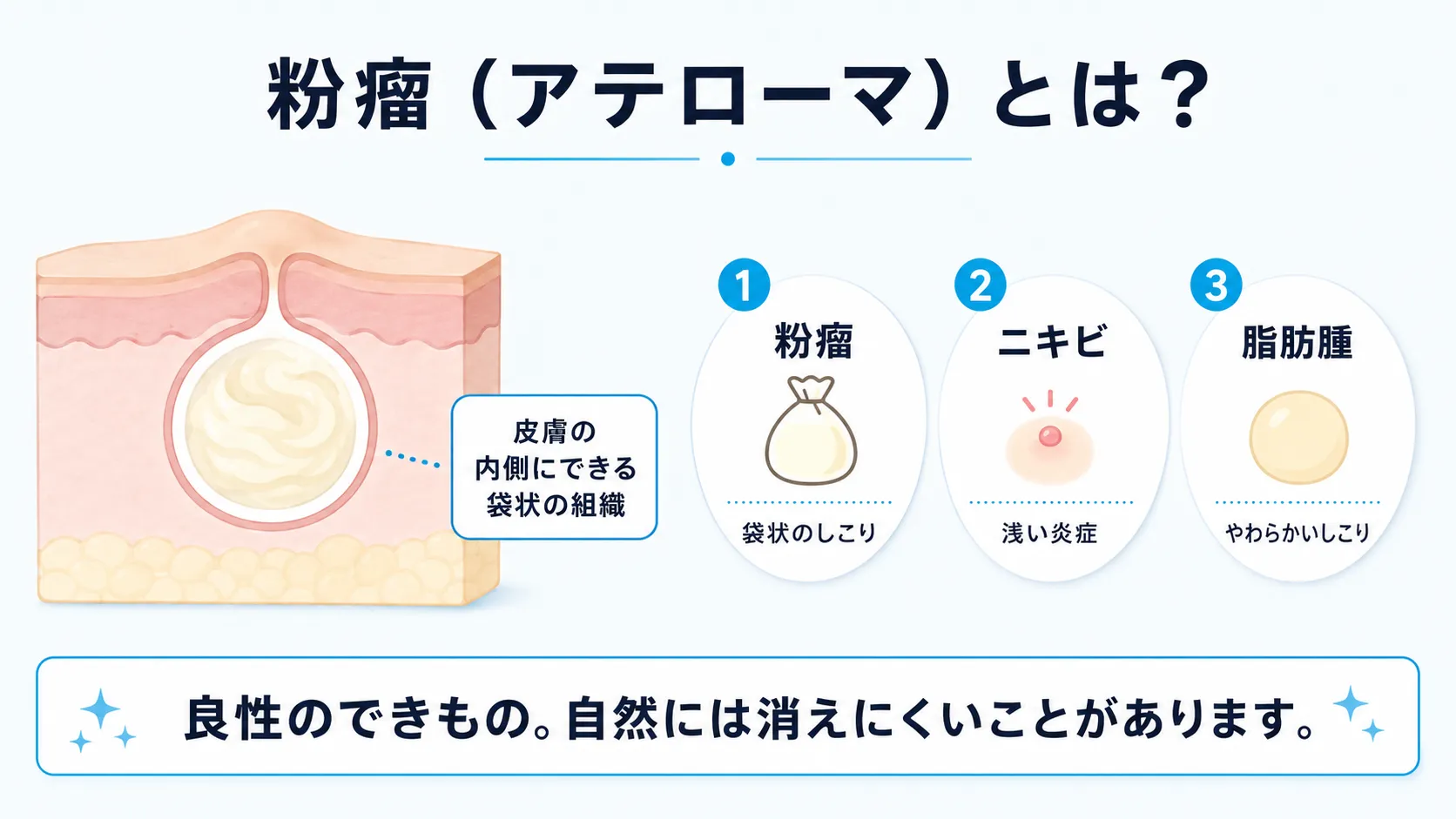粉瘤の構造と特徴をイラストで解説したインフォグラフィック
