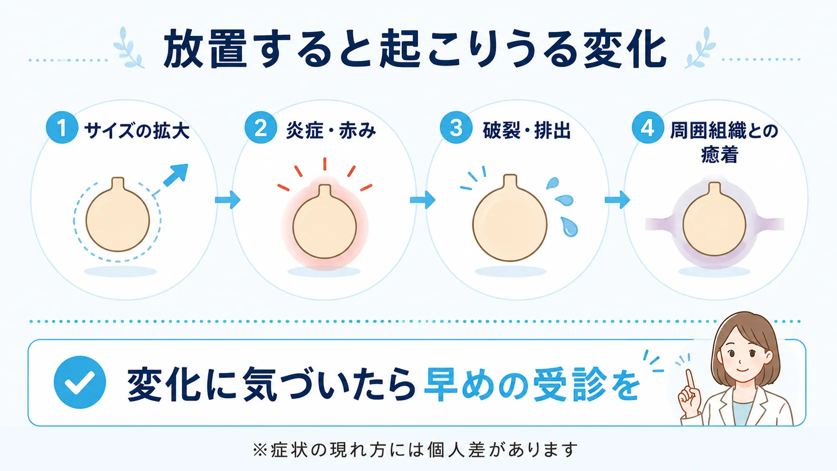 粉瘤を放置した場合に起こりうる変化を4段階で示したインフォグラフィック