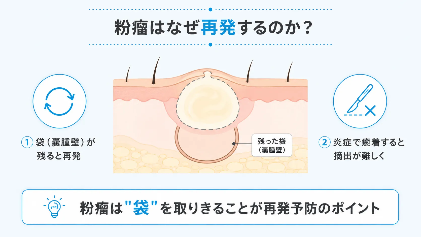 粉瘤の袋(嚢腫壁)が残ることで再発する仕組みを示したインフォグラフィック