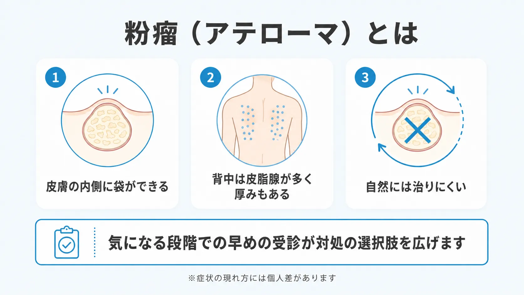 粉瘤の構造と背中にできやすい理由を示すインフォグラフィック