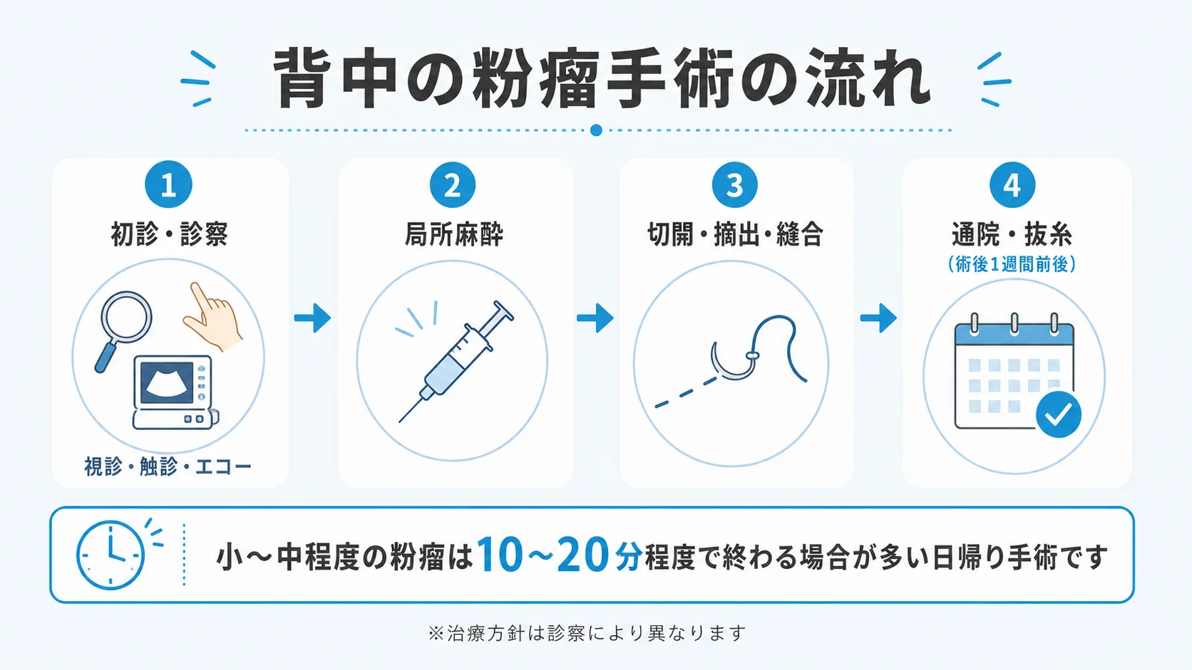 背中の粉瘤手術の流れを4ステップで示すインフォグラフィック
