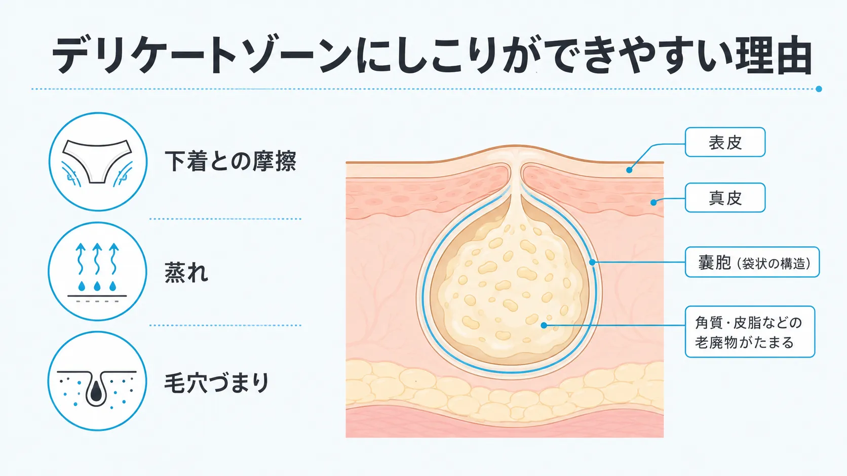 デリケートゾーンにしこりができやすい理由と粉瘤の構造を示す図解