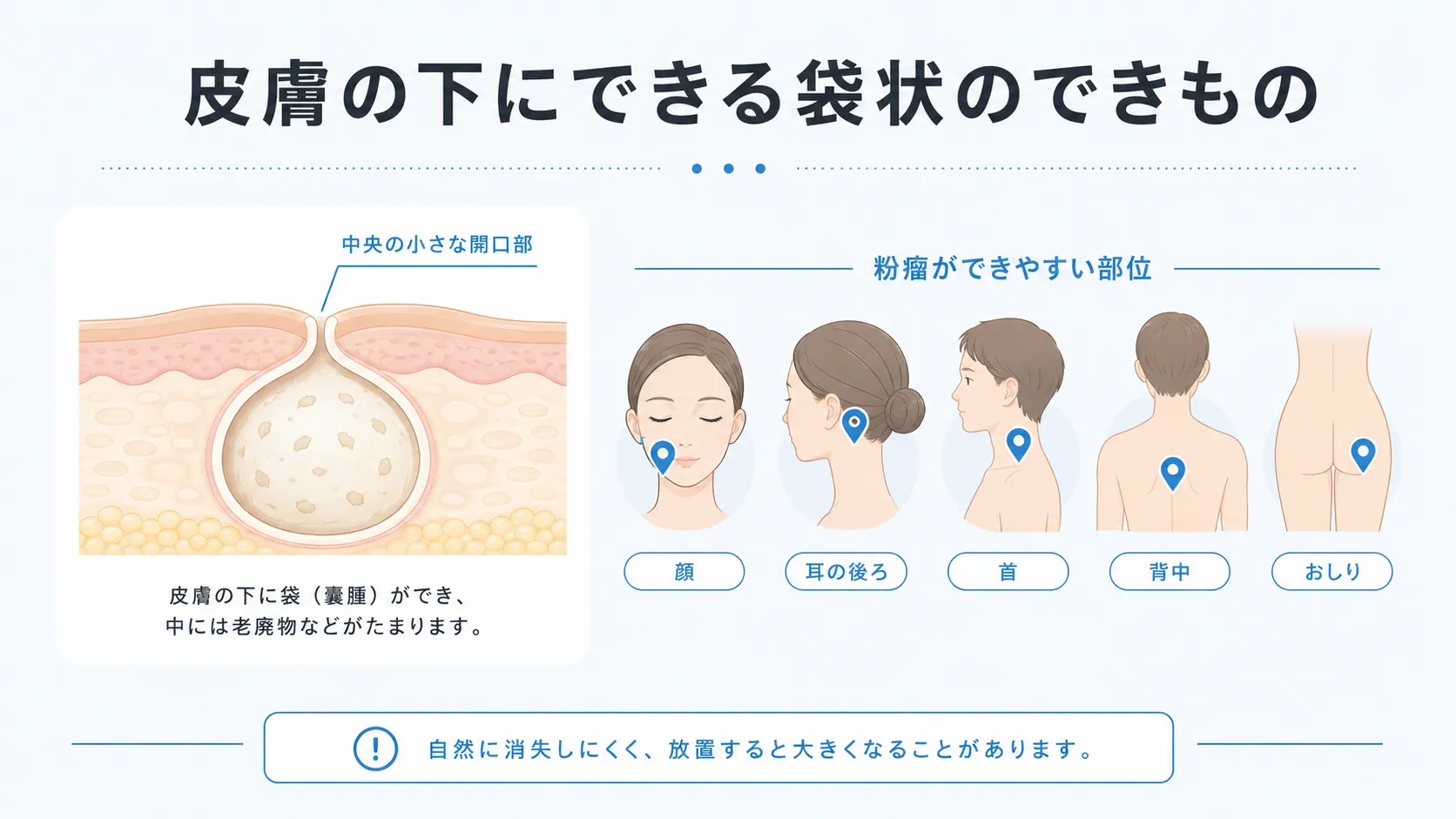 粉瘤は皮膚の下に袋状の構造ができる良性のできものであることを示す図解