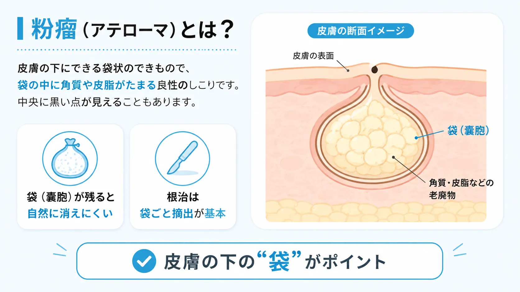 皮膚の下に袋状の嚢胞ができ角質や皮脂がたまる粉瘤（アテローマ）の断面図と特徴を示したインフォグラフィック