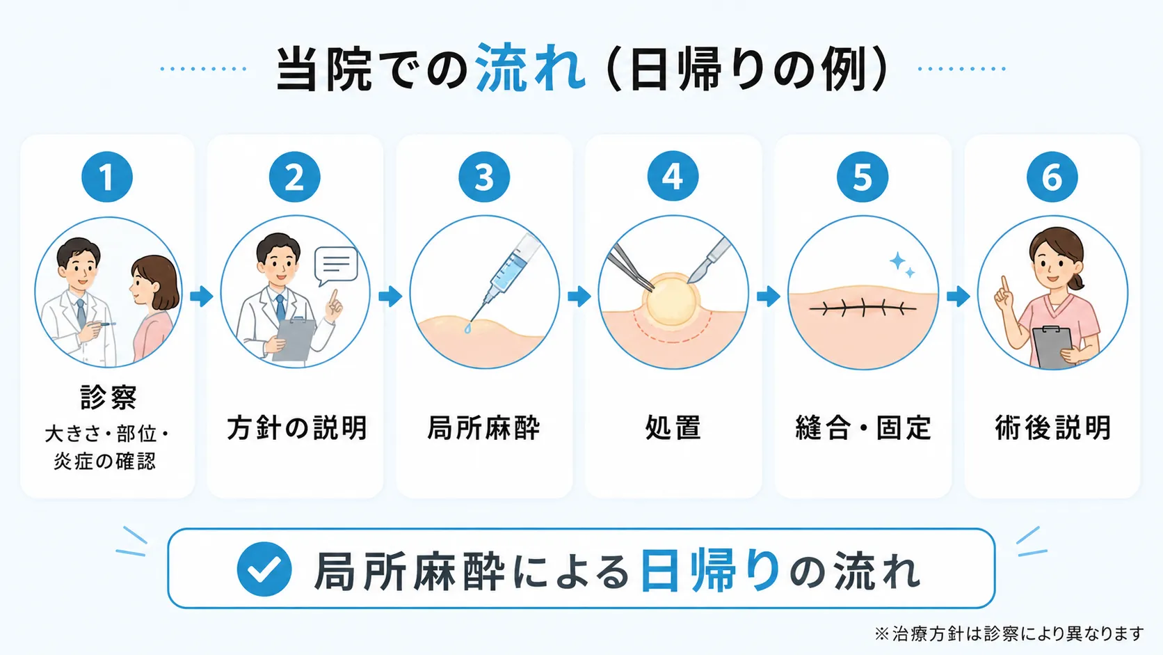 診察から術後説明まで局所麻酔による粉瘤日帰り手術の6ステップの流れを示したインフォグラフィック
