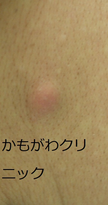 背中にできた粉瘤の写真。皮脂腺が多い部位に生じた例