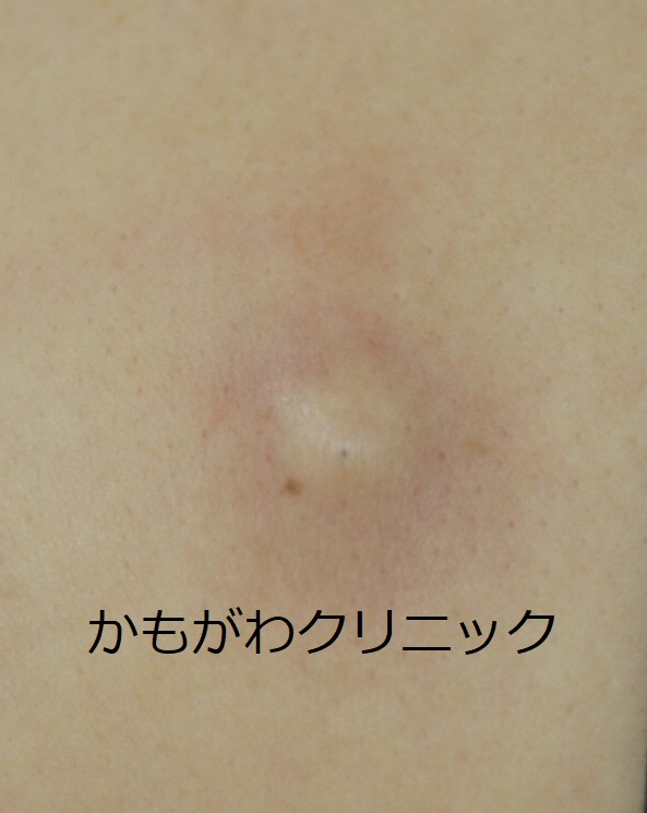背中の粉瘤の別の例。皮膚の下に丸いしこりとして触れる状態