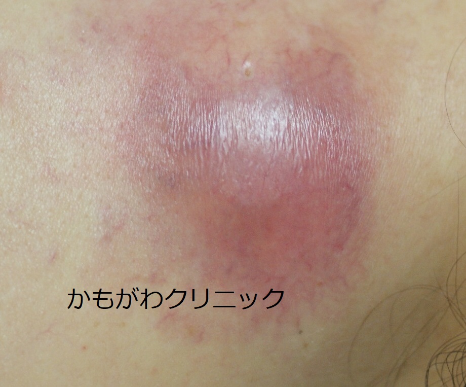 背中の粉瘤の例。大きさや部位により見え方が異なることを示す写真