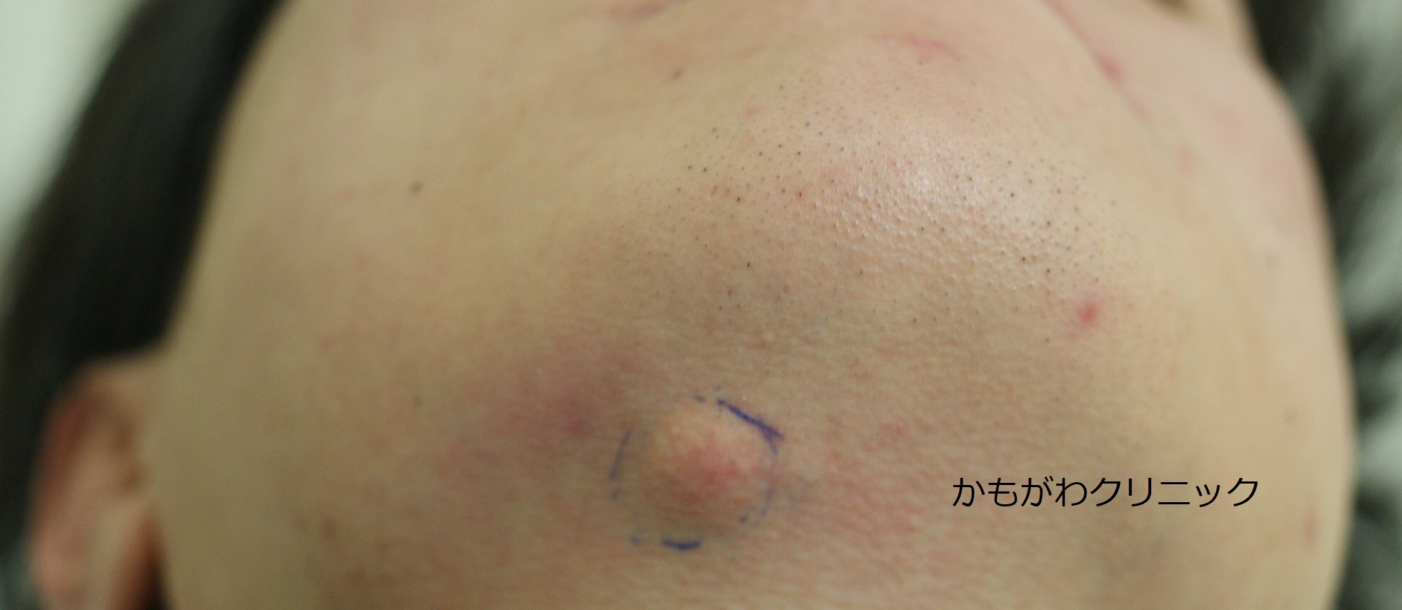 粉瘤の見た目の一例。あごの皮膚の下に丸いしこりとして現れている