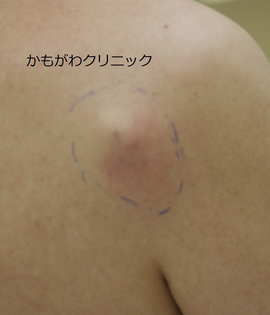 肩にできた粉瘤の写真。皮膚の下のドーム状のふくらみとして現れている例