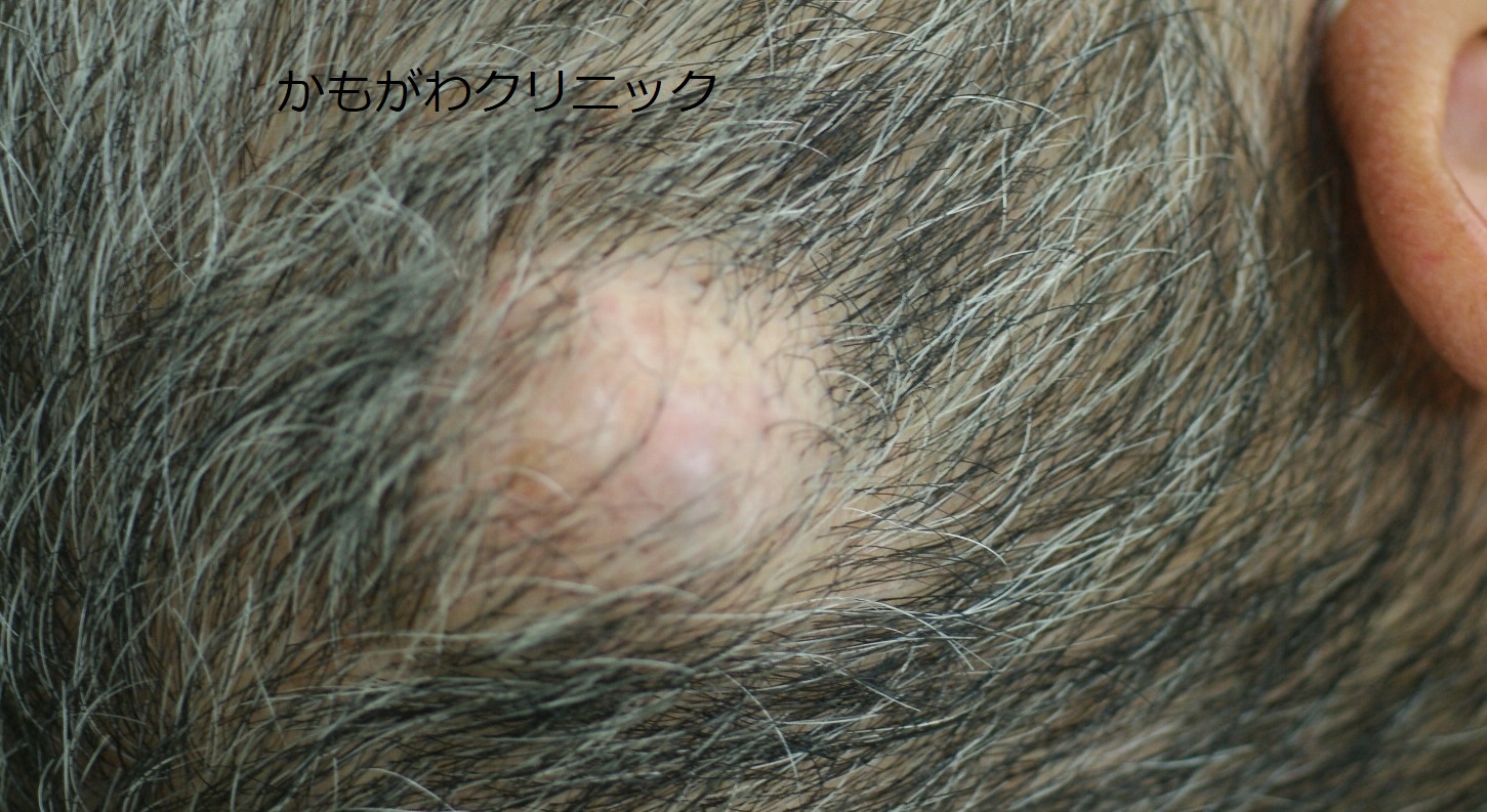 側頭部の粉瘤の別の例。見た目だけでは他のできものとの区別が難しい状態