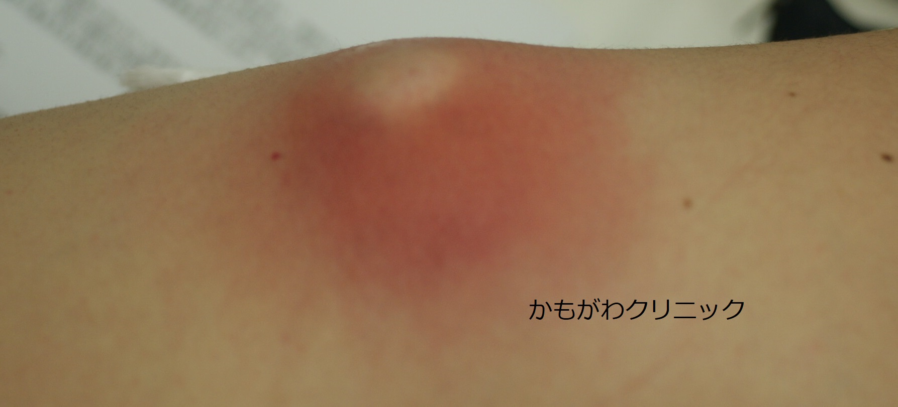 大腿部にできた粉瘤の写真。皮膚の下のしこりとして現れている例