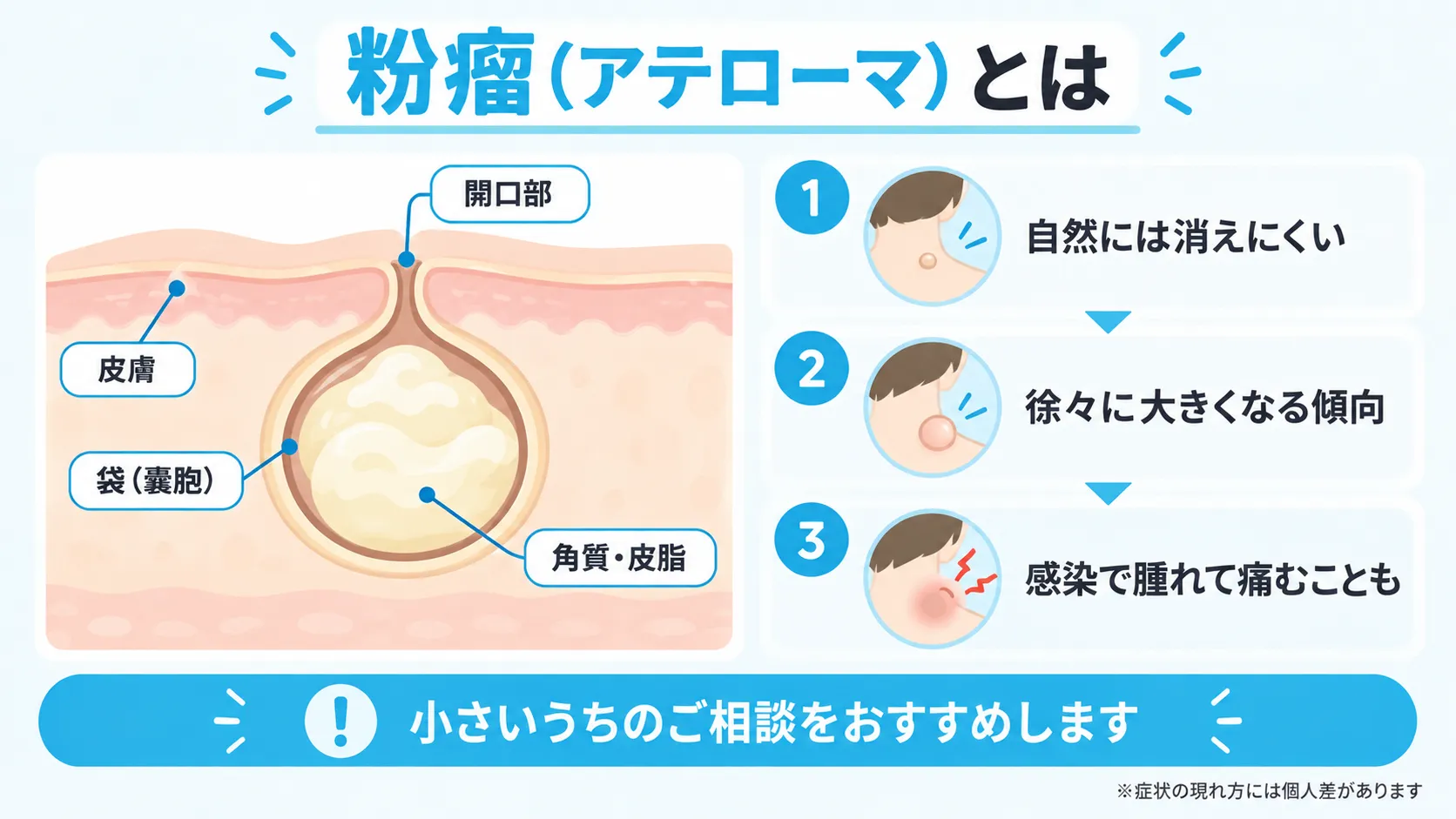 皮膚の下にできる粉瘤の袋の模式図と放置した場合の経過を示した図
