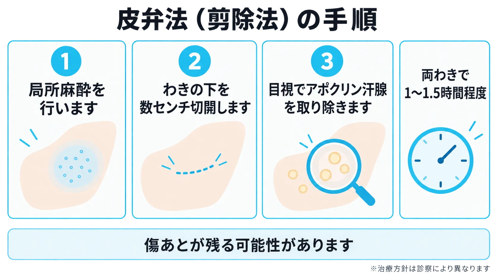 皮弁法の手順を3ステップで簡略化して示した図